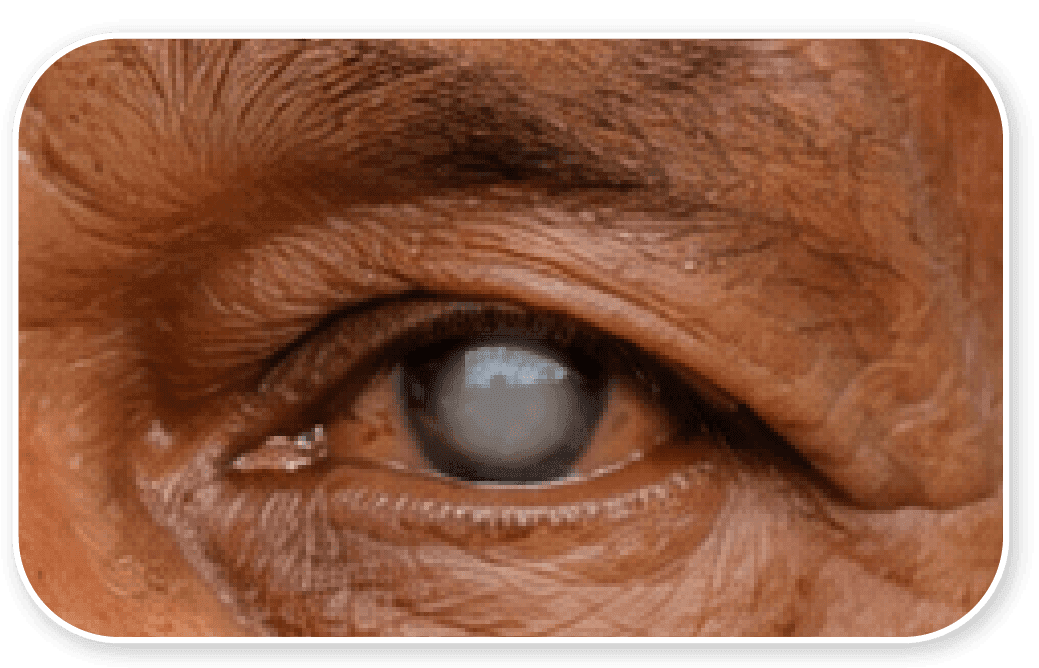 Cataract eye detail